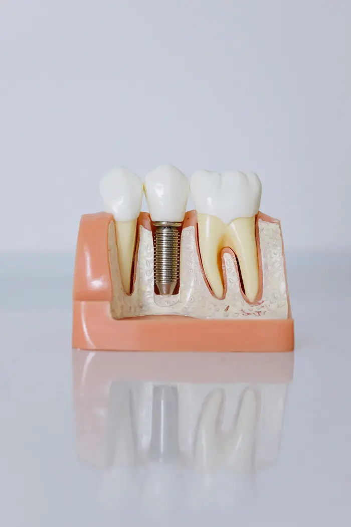 Single Tooth Implant vs Bridge: Which Replacement Option Is Right for You?