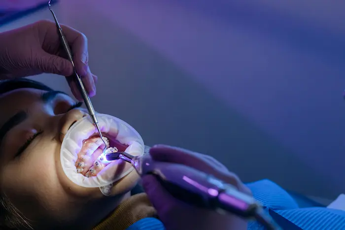 Professional Teeth Whitening: Brighten Your Smile Safely